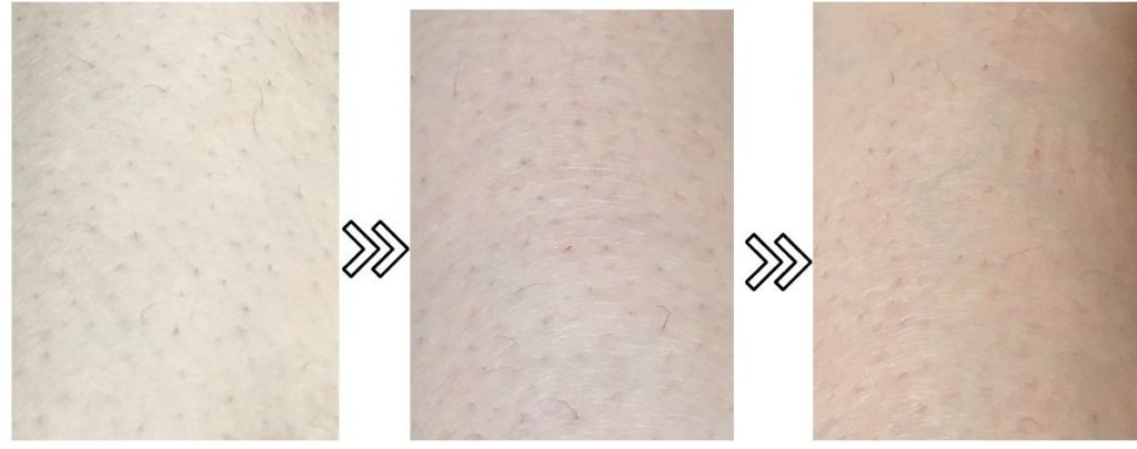 トリア パーソナルレーザー脱毛器４xの口コミ 産毛に効果なし 超痛い 東京ナイロンガールズ 脱毛器と美容家電の口コミ紹介サイト