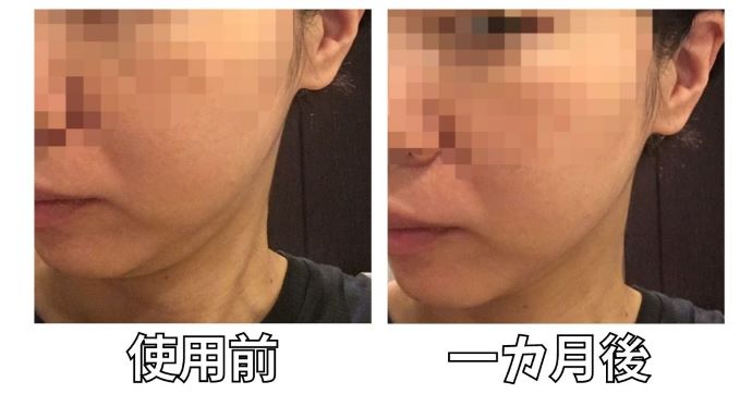 アイスレディ美顔器口コミ【フェイスインベストメント（顔面投資）効果 